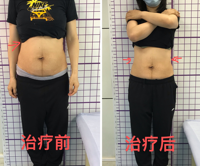波后私美产后修复真实体验分享 波后私美产后修复真实体验分享